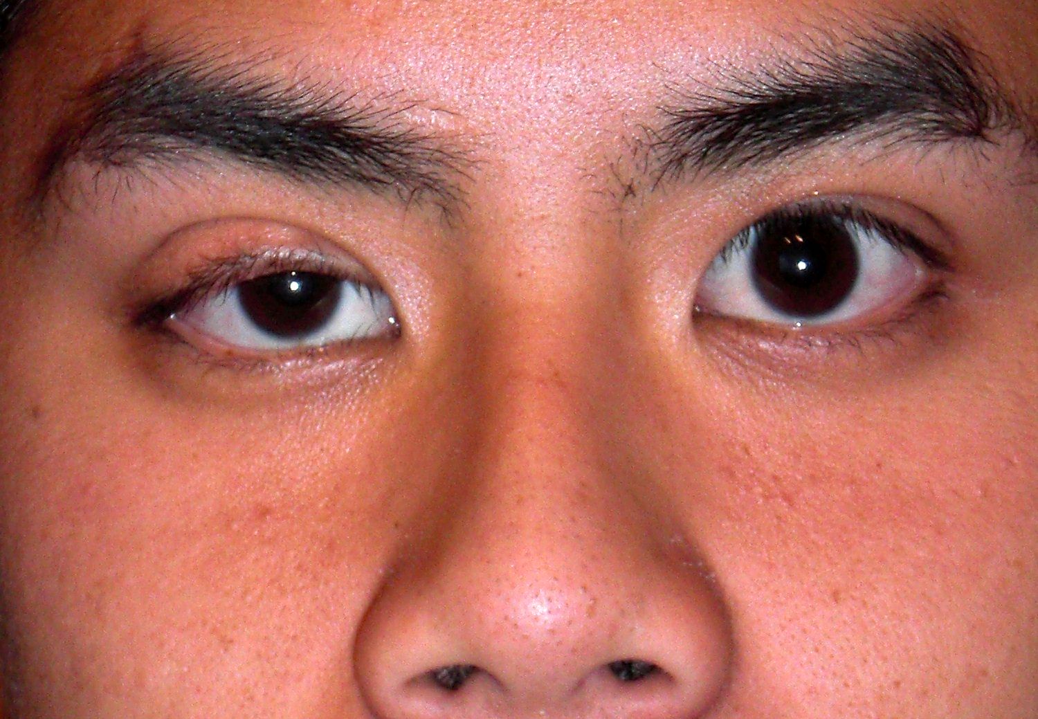Child with congenital drooping of an upper eyelid