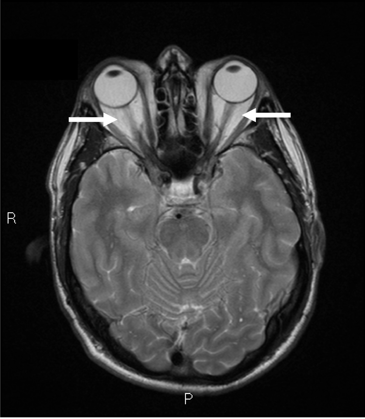 MRI showing enlarged eye muscles in thyroid eye disease