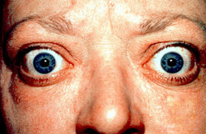 Clinical example of proptosis associated with Graves thyroid eye disease