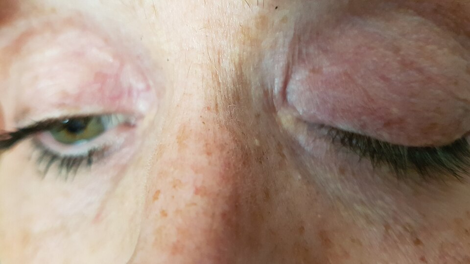 Clinical example showing drooping of an upper eyelid