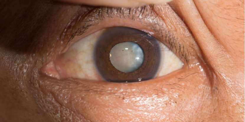 Close view of the eye and lower eyelid