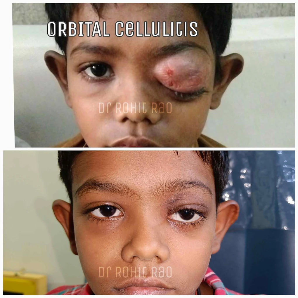 Clinical outcome case 4